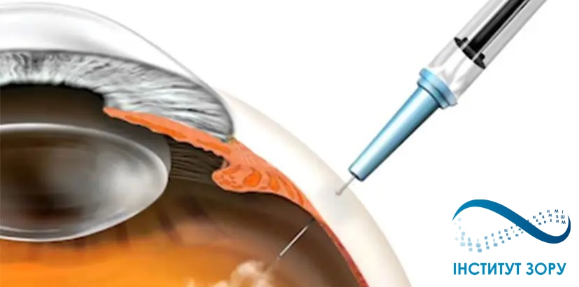 Як виконується процедура інтравітреальної ін'єкції в МЦ «Інститут зору»?